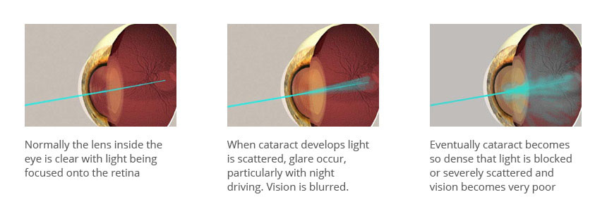 Cataract development within the eye