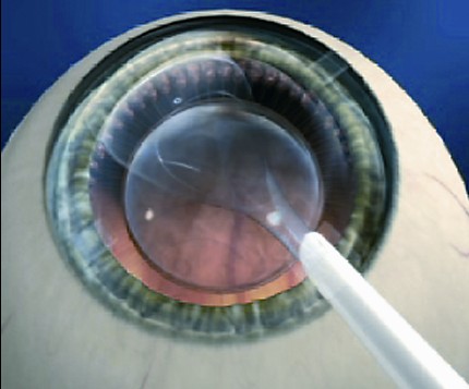 Implantable Contact Lens at the corner of the eye