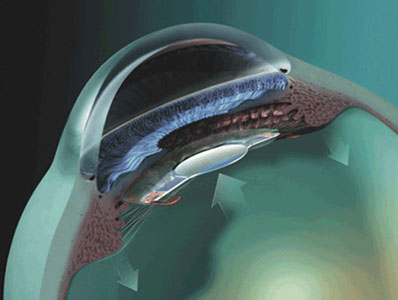 Lens implants for people with cataract