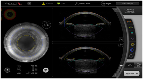 automatic eye surface mapping using anatomic landmarks
