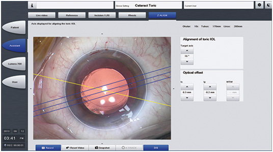 precise and efficient toric iol alignment in cataract surgery