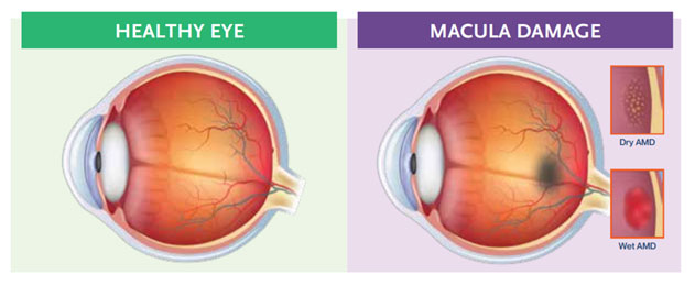 The difference between an health eye and an eye with macular damage