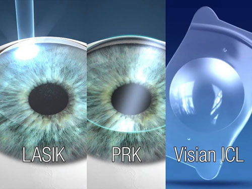 Comparison between Lasik, PRK and ICL