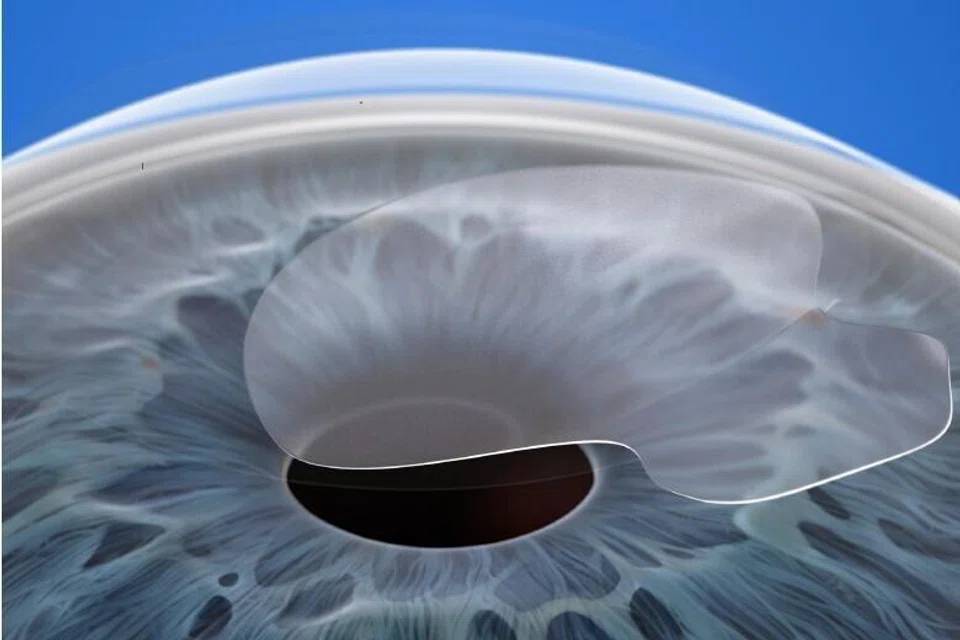 Silk Procedure