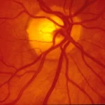 Macular Degeneration Singapore