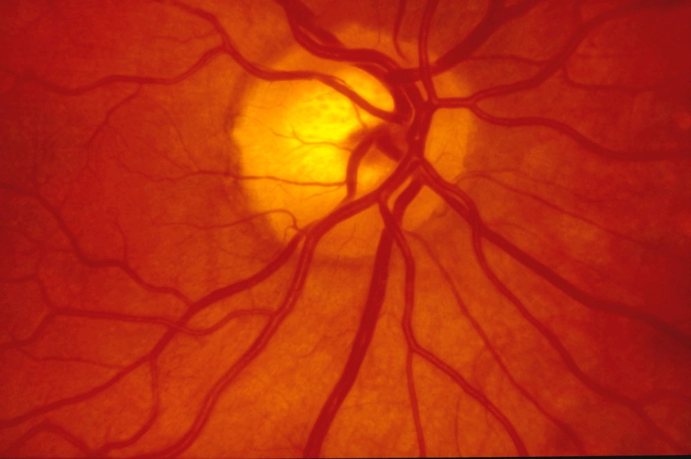 Macular Degeneration Singapore