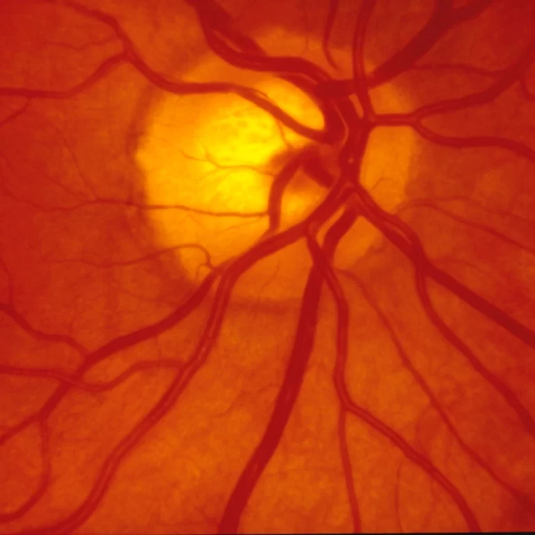 Macular Degeneration Singapore