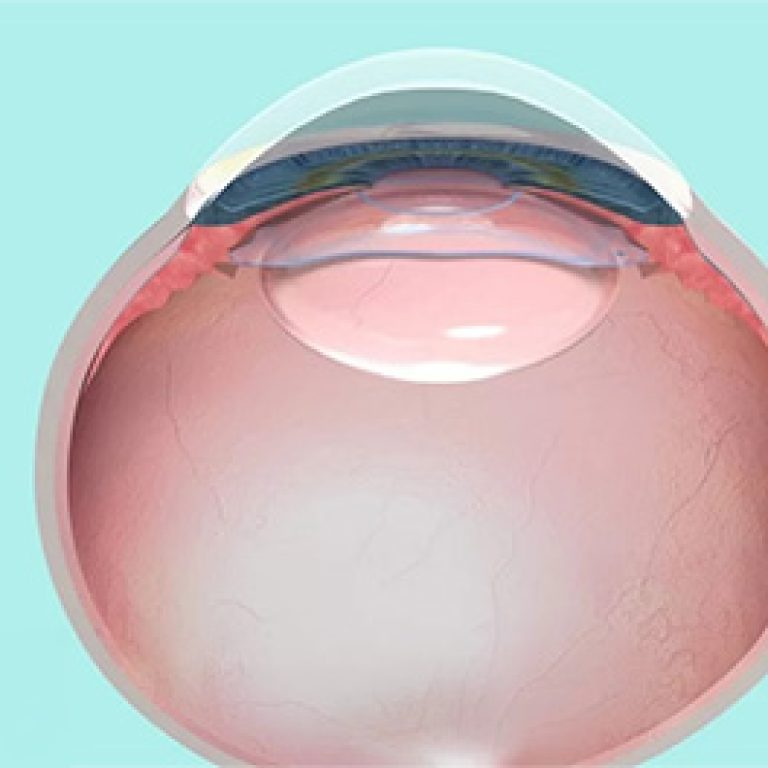 eye-lens